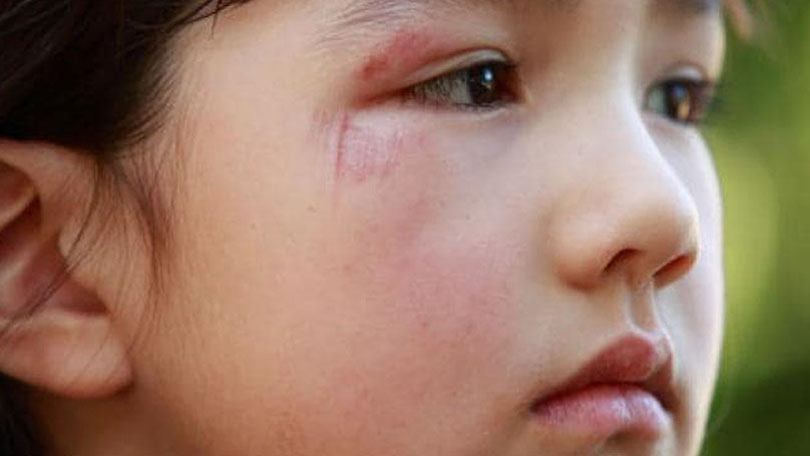 Child Abuse and Neglect How to Spot the Signs